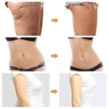 Liposuction Machine EMS VE Sport Belly Arm Leg Fat Burner Body Shaping Slimming Anti Cellulite Massager Fitness Weight Loss - Image 3